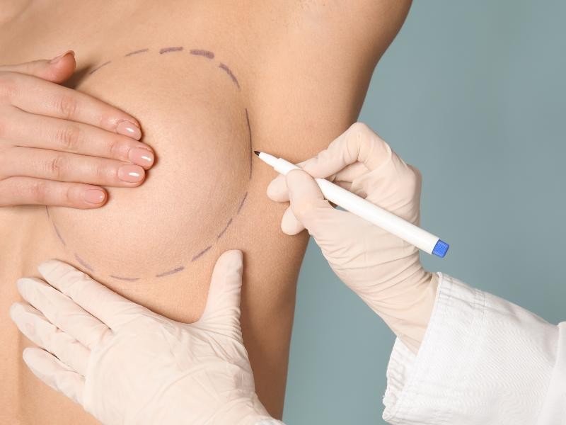 Mamoplastia Redutora Pós-Bariátrica pelo Plano de Saúde: Como Obter a Cirurgia para Diminuição das Mamas