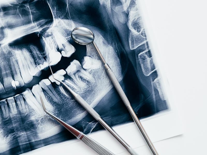 Como Obter Cobertura da Cirurgia Bucomaxilofacial pelo Plano de Saúde?