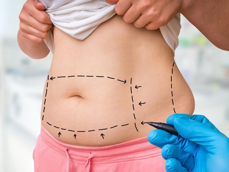 Erro Médico em Procedimentos Estéticos: Abdominoplastia e Lipoaspiração